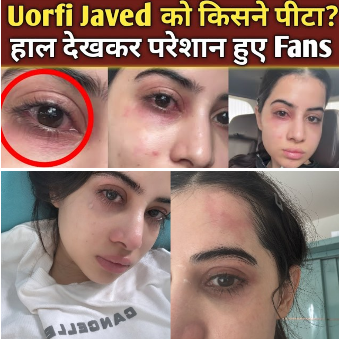 Fans Shocked as Urfi Javed Injured in Shocking Incident – Who Was Responsible?